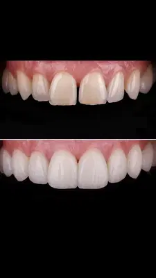 LA Dental Experts Century City - Invisalign, Implants, Veneers