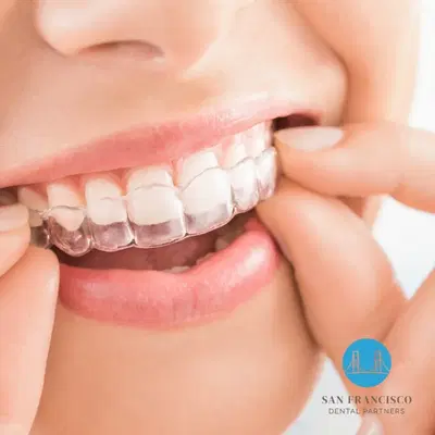 San Francisco Dental Partners | General, Cosmetic and Implant Dentist