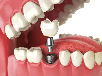 New Image Dental | Muneet Nanda, DMD | Dentist West Hartford