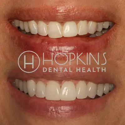 Hopkins Dental Health: Cosmetic Dentistry
