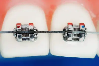 Yo! Braces Orthodontics (Invisalign, frenillos, ortodoncista, and more!)
