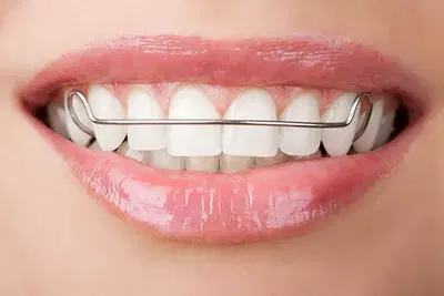 Teeth Retainer After Braces