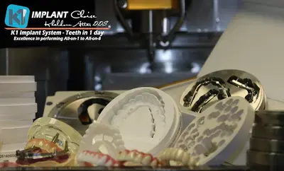 K1 Implant Choice | Full Mouth Dental Implants in One Day | All-On-4