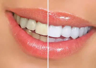 Beechmont Dental